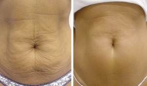 cellulite-belly-vitality-laser-spa
