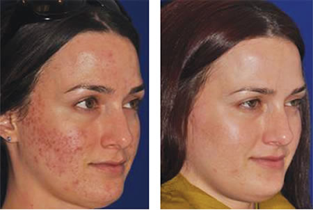 before-after-scars-vitality-spa