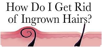 how-to-get-rid-of-ingrown-hair
