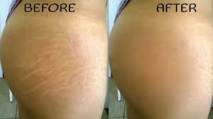 Red stretch marks: Causes and treatment options